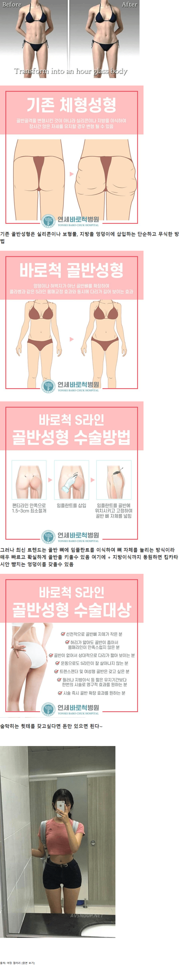 image.png ㅇㅇㅎ?)요즘 골반 성형하는 방법.jpg